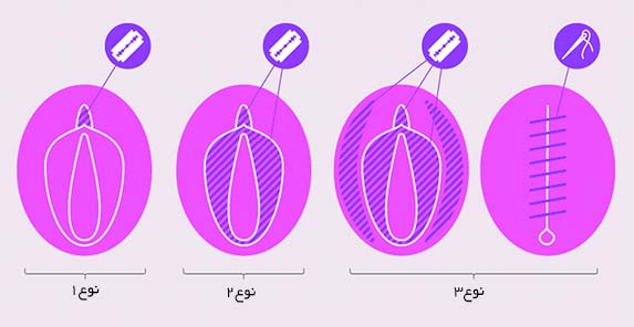 ختنه دختران