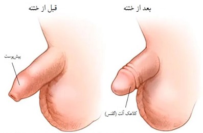 ختنه سنتی چیست؟